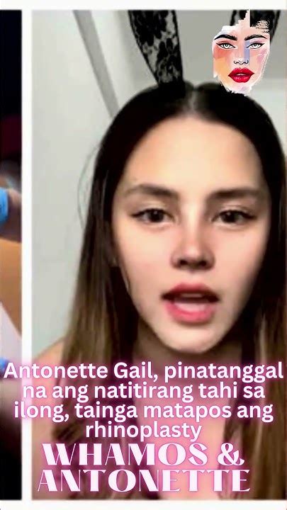 antonette gail porn|Antonette Gail, pinatanggal na ang natitirang tahi sa ilong, tainga .